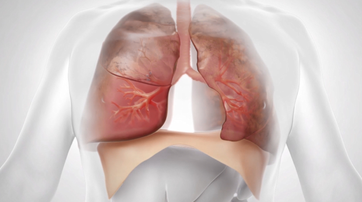 lung-20211231_g12.jpg