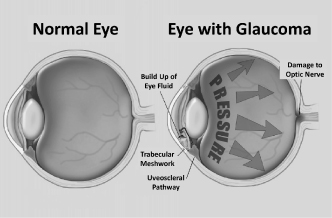 f-eyewithglaucomaa03.jpg