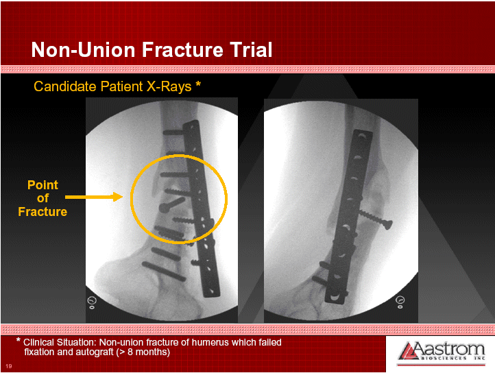 (NON-UNION FRACTURE TRIAL X-RAYS)