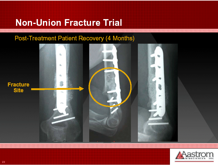 (NON-UNION FRACTURE TRIAL X-RAYS)