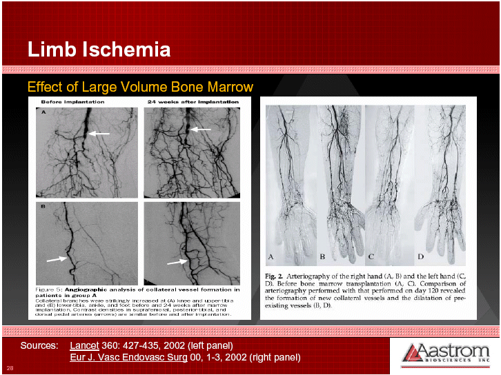 (LIMB ISCHEMIA BONE MARROW PROCESS)