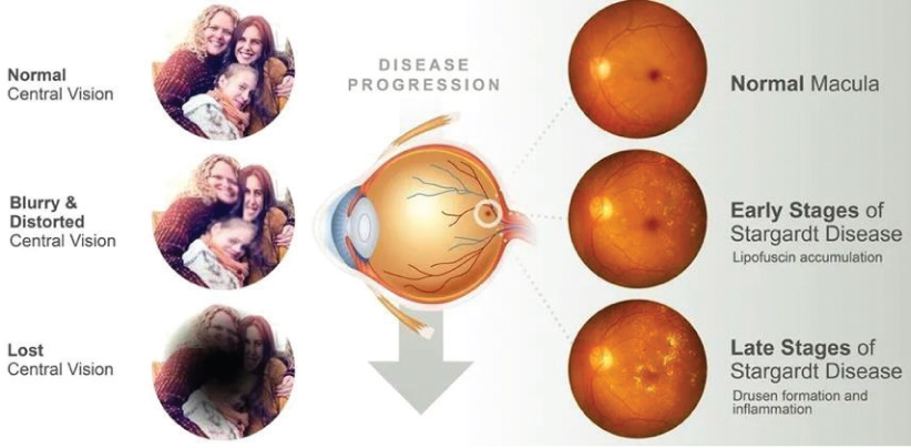 [MISSING IMAGE: tm2132809d4-ph_disease4clr.jpg]