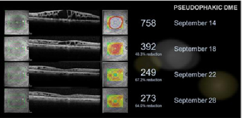 [MISSING IMAGE: tv489365_anterior-uveitis.jpg]